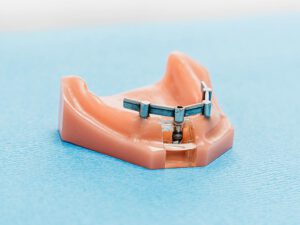 Zahnprothesen und Implantate in der Zahnarztpraxis in Daaden
